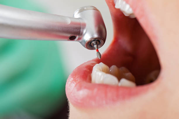 Best Emergency Dental Extractions in Blackhawk, CA